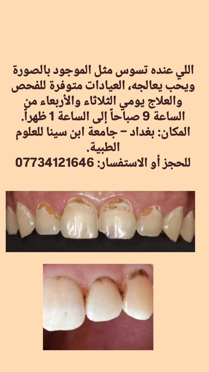 ✨العلاج مجاني 🦷
فحص الاسنان_حشوات ضوئية _تنظيف الاسنان_قلع الاسنان
📍 بغداد _القادسية_جامعة ابن سينا للعلوم الطبية _ مقابل بلدية الرشيد

للحجز:***********
