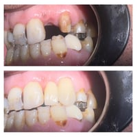 تركيب زاركون ثابت نوع فيتا الماني طبيب الاسنان الاختصاص د.عمار عباس ما...