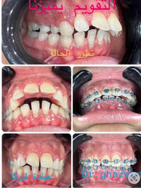 التقويم يميزنا احد حالات العضة المفتوحة و عدم الاطباق مشاكل في المظهر ...