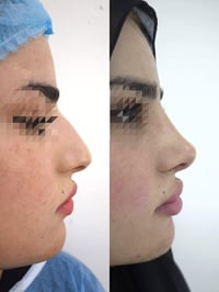 تجميل الأنف • دكتور محمود أحمد • الشطرة