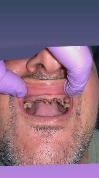 السلام عليكم
تقدم عيادات جامعة الصفوه خدماتها المجانيه
قلع اسنان تالفه وجذور وتعويض ب طقم متحرك 
للتواصل ***********
