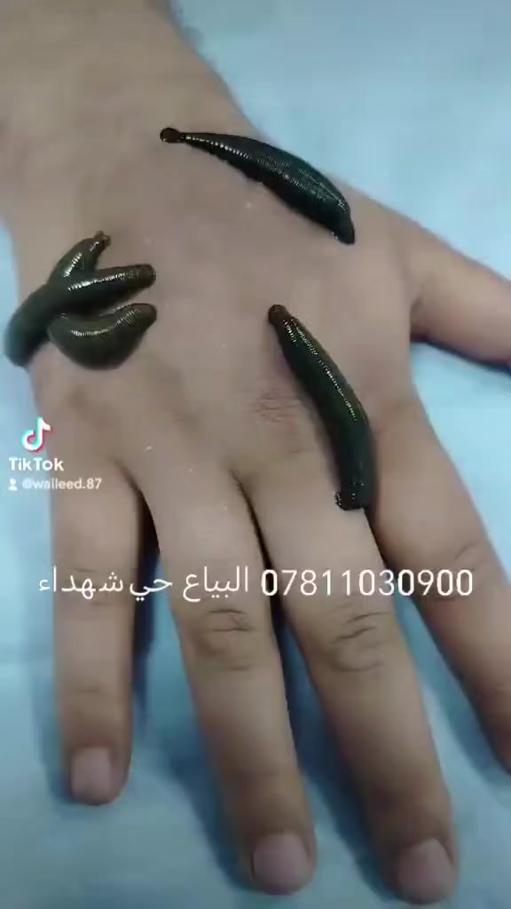 تم علاج بل علق طبي رقم الحجز ***********#بغداد البياع حي شهداء خلف سوق رضا
