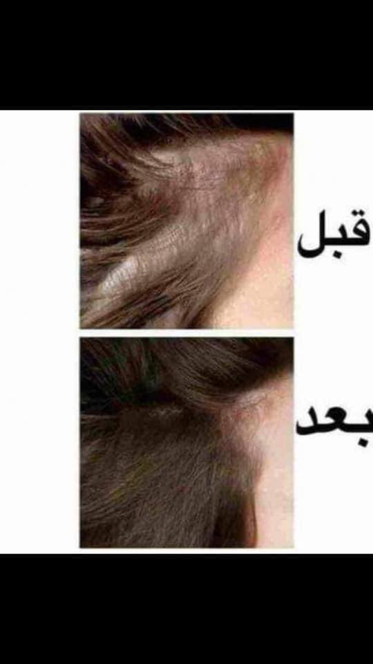 أفضل علاج لتساقط الشعر
بكج امبولات كوين لتساقط شعر 
لكثرة الطلب عليها وكثرة التجارب الرائعة في وقف التساقط وفرناها لكم مرة اخرى

بكج امبولات علاج تساقط الشعر وبطأ النمو والتقصف وضعف بصيلات الشعر امبولات كوين الايطاليه لوقف لتساقط الشعر وتعالج ضعفه أبر كوين مصنوعة من الكرياتين و جينسنج والثوم اعشاب طبيعية معالجه مضمونه للتساقط والتقصف وينظم عمل الغدد الدهنية بالاضافة الى تكييف فروة الرأس ومنع عملية ترقق وضعف الشعر ويساعد على نمو الشعر 

1- تغذي بصيلات الشعر و تعيد نشاطها وحيويتها 
2- تمنع التساقط الشعر حتى الوراثي نهائياً 
3- تقوي الشعر وتعيد كثافه الشعر 

20 امبولة السيت 

  توصيل لجميع محافظات العراق ٤ الاف


**إذا كنت صاحب هذا الإعلان وتريد حذفه لأي سبب، رجاءا أرسل رسالة إلى الدعم الفني**