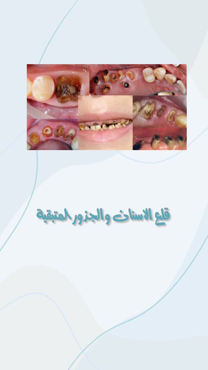 عروض مجانية لشهر رمضان المبارك
قلع الاسنان والجذور التالفة
تنظيف الاسنان
معالجة (حشوات) تجميلية للاسنان
معالجة (حشوات ) تجميلية للأطفال
حشوات جذور
لتواصل والاستفسار : واتساب : ***********
العنوان #ميسان #العمارة #جامعة_المنارة
