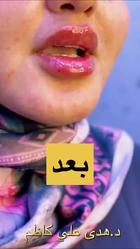 فيلر • كنتور الشفايف • العمارة