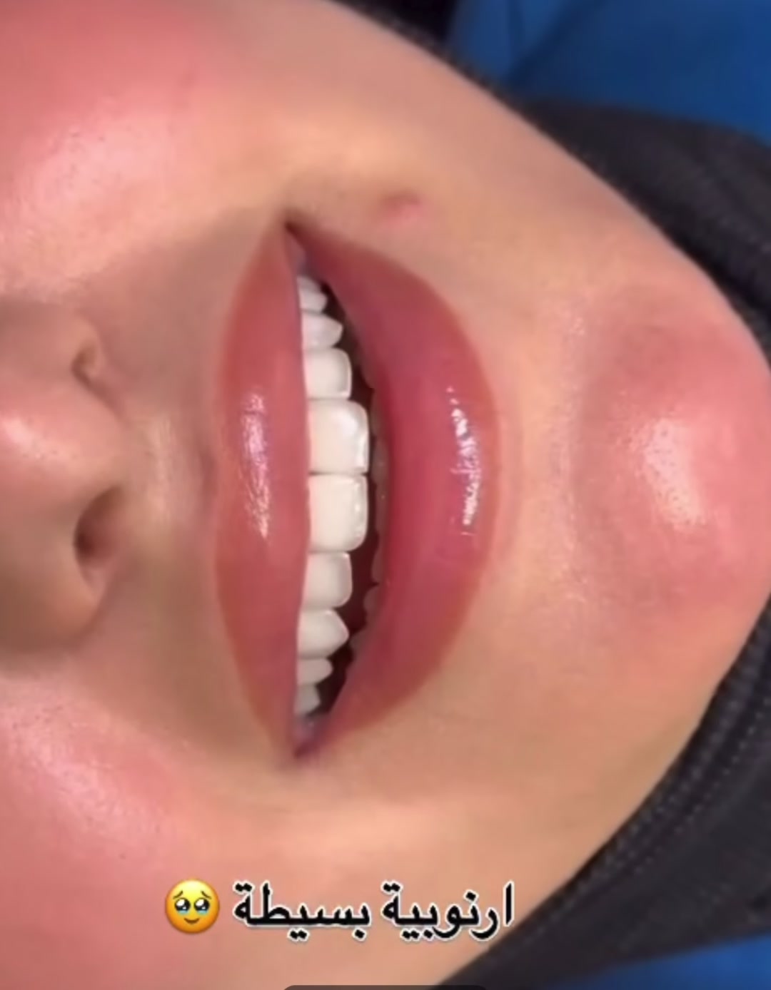 احلى من يبتسم …🦷❤️🙂‍↔️

ابتسامة أرنبية وبلون ابيض طبيعي 

الابتسامة نوع زيركون ودائمية مع الضمان 💯♥️
.
.
.
عنوان العيادة 🦷🤍✨

الرمادي _شارع المستودع _مجمع النخبة الطبي 
مبنى المحافظة مقابيل الضريبة القديمة مباشرة
 

للحجز والاستفسار الاتصال ع الرقم: ***********
او مراسلة صفحة العيادة 

أوقات الدوام من الساعة من ١١ صباحاإلى الساعة ٩ ليلا
