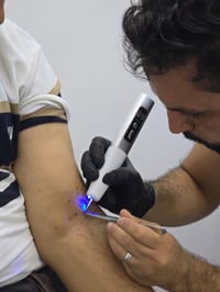 زوائد لحمية • أحدث الأجهزة • ناحية صباغية