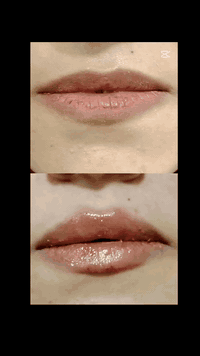 فلر شفة • ابتسامة لثوية • بعقوبة التحرير