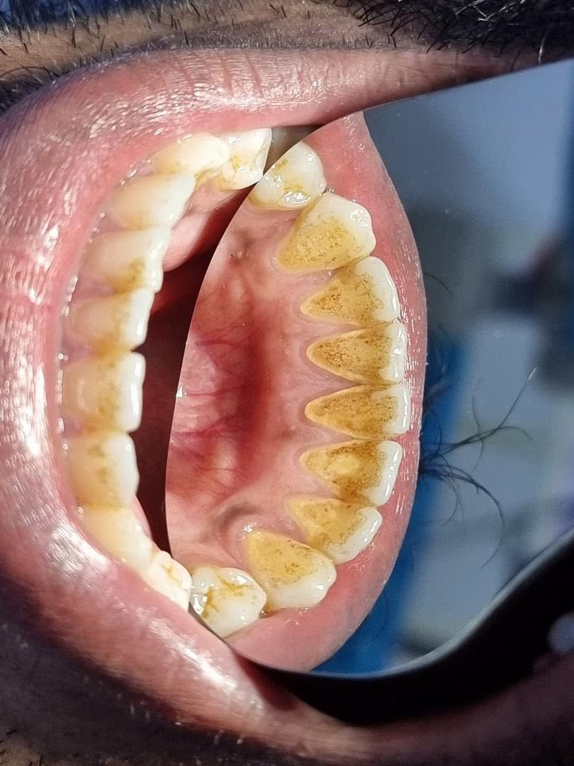 ابتسامتك تبدأ من أسنان نظيفة وصحية ✨

تنظيف الأسنان بشكل دوري يساعد على إزالة الترسبات والجير، ويحافظ على صحة اللثة ويمنحك نفسًا منعشًا وابتسامة أجمل. 🦷💙

#عيادة_كوثى_لطب_وتجميل_الاسنان
#الدكتور_علي_حسن_العزاوي 
جبله/نهاية شارع الاطباء
مقابيل الدكتوره ميثاق المعموري

***********//للاستفسار
