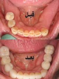 🟢 خدمـــة مجــانية   1⃣ قلع جذور الاسنان المتبقية ✅  2⃣ تعــويض الاسنا...