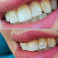 تنظيف اسنان • تبييض ليزر • مجمع اليمامه