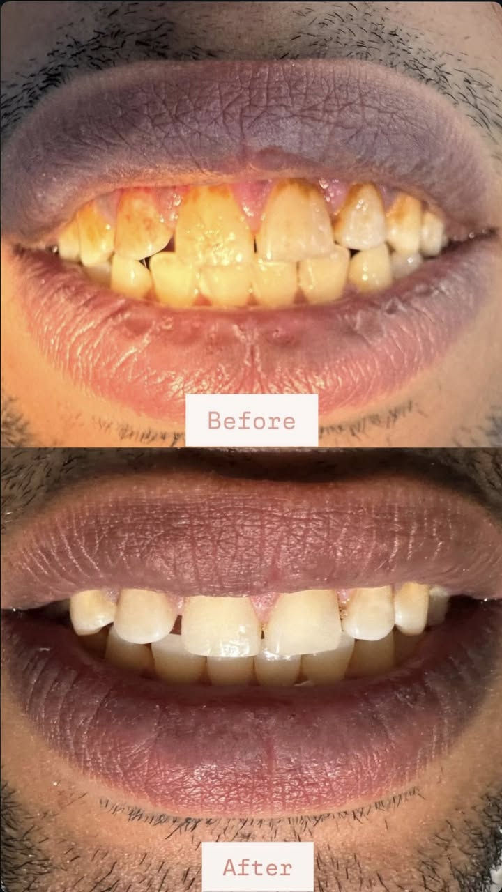 السلام عليكم💗💗
استقبال المرضى في عيادات كلية طب الأسنان في جامعة اهل البيت (ع).

المعالجة مجانية وبإشراف أخصائيين 

المعالجات المتوفرة:
🔶قلع أسنان
🔶التعويضات بأطقم متحركة
🔶 حشوات ضوئية 
🔶تنظيف الاسنان وازالة التكلسات 

الرجاء التواصل على الحسابات التالية:

الإنستغرام: 10_marb 
الواتساب:***********
