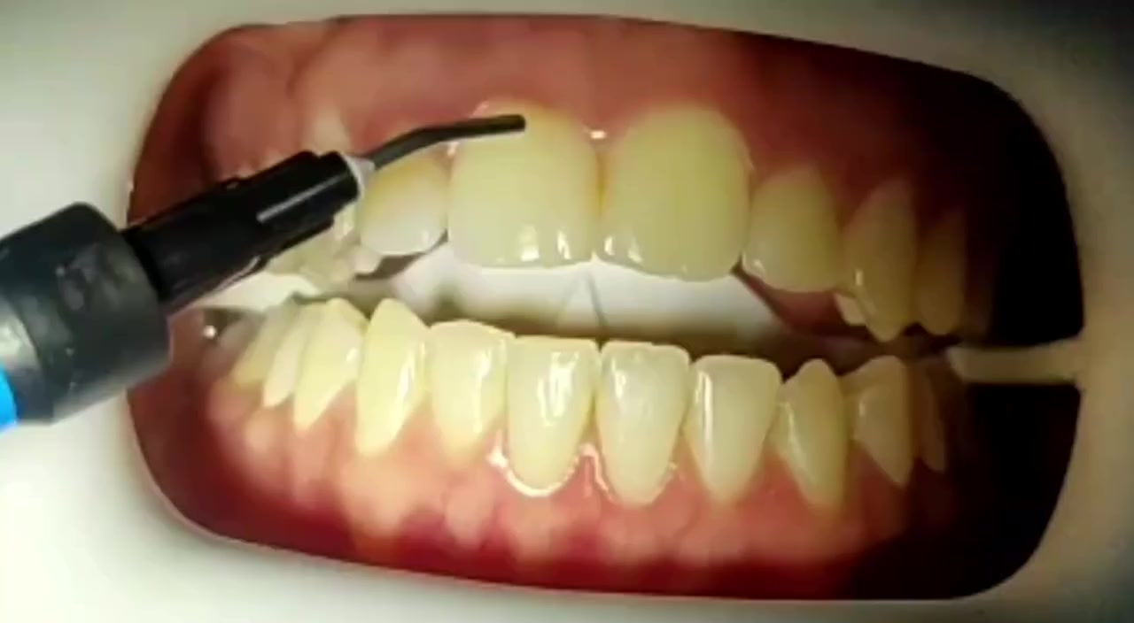 📍 عيادة لؤلؤة بدرة
📞 للحجز والاستفسار: ***********

فوائد تبيض لاسنان 
ابتسامه اجمل واكثر جاذبيه
 تفتيح لون لاسنان وجعلها تبدو جميله واكثر اشراقا  لتحسين المضهر العام 
لاسنان البيضاء تعطي انطباعا بصحه جيده ونضافه عاليه 
لكي يدوم التبيض اكثر يجب علينا لاتزام والتخلص من البقع والتصبغات  
✓يقلل من شرب القهوة والشاي والتدخين او الاطعمه الملونه

ابتسامتك مسؤوليتنا 🌸

لا تتردد… خلّي ابتسامتك تحچي عنك �
