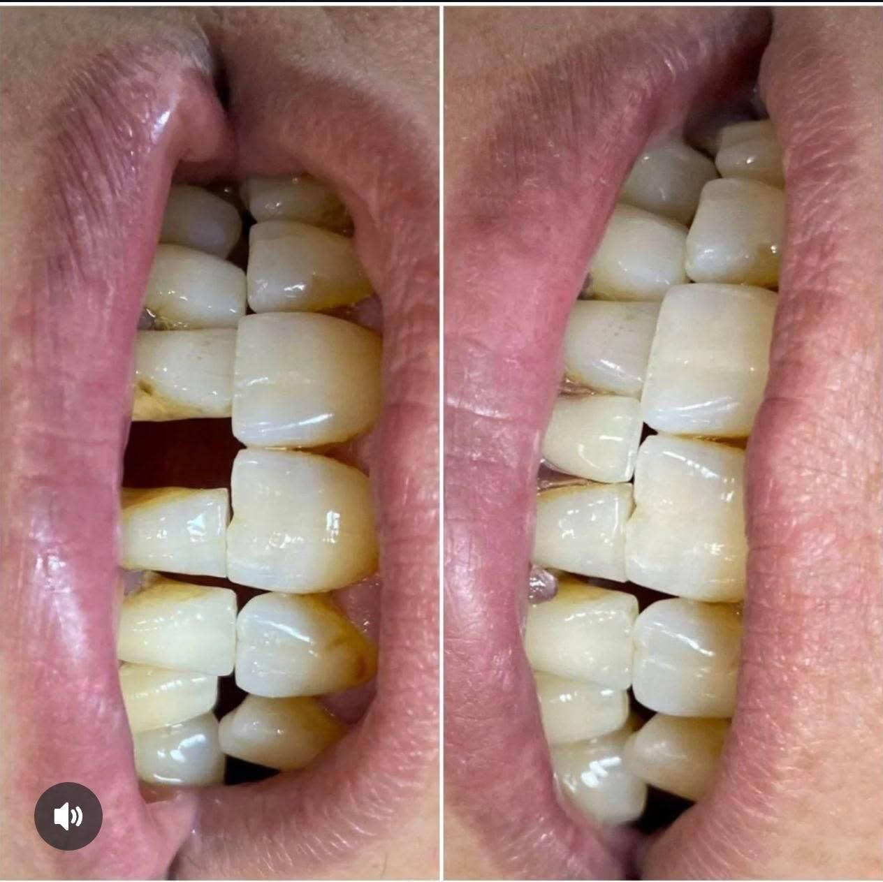 السلام عليكم 
الي محتاج تعويض اسنان خلفية متوفر طقم جزئي متحرك مجانا يوم الثلاثاء غدا في عيادات جامعة بغداد كلية طب الاسنان-باب المعظم (مدينة الطب)
***********
