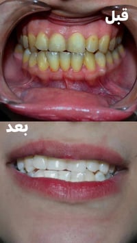 تبييض بالليزر • جلسة واحدة • حي ١٧