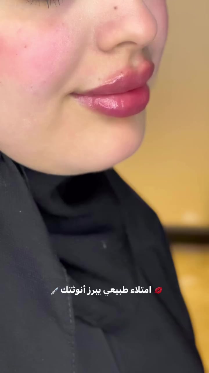 💋 امتلاء طبيعي يبرز أنوثتك💉
  #تجميل #فيلر


**إذا كنت صاحب هذا الإعلان وتريد حذفه لأي سبب، رجاءا أرسل رسالة إلى الدعم الفني**