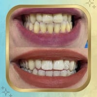 ✨عروض تنظيف الاسنان مع شذرة اسنان هدية ✨  للحجز و الاستفسار مراسلة الص...