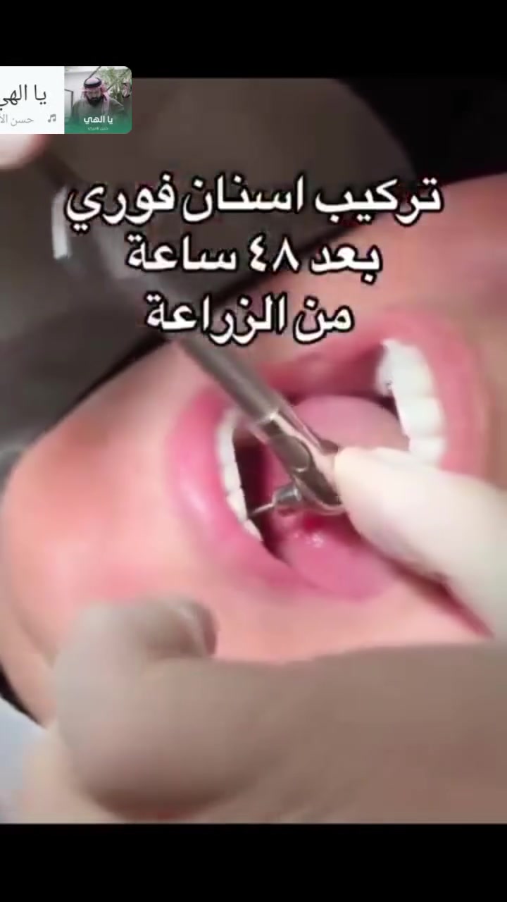 🦷 استعد ابتسامتك بثقة!
في عيادة الدكتور احمد الجنابي لطب وتجميل الاسنان  نوفر لكم أفضل أنواع زراعة الأسنان بجودة عالية وأسعار منافسة تناسب الجميع.
✅ زرعات أصلية وموثوقة
✅ بإشراف طبي وخبرة متميزة
✅ نظام أقساط مريح لتسهيل العلاج
✅ استشارة وتقييم الحالة قبل البدء
لا تؤجل ابتسامتك... احجز موعدك اليوم، وخلي أول خطوة نحو ابتسامة أجمل تبدأ ويانا.


**إذا كنت صاحب هذا الإعلان وتريد حذفه لأي سبب، رجاءا أرسل رسالة إلى الدعم الفني**