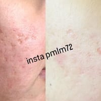 ✨ بشرتك تستاهل الفرق ✨  📌 شوفوا النتيجة المبهرة لزبونتنا الغالية بعد ١...