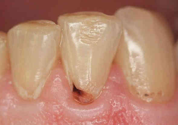 السلام عليكم: اي شخص عنده مثل هيج حالات مال التسوس ومحتاج حشوات ضوئية يتواصل وياي خاص او واتساب *********** علماً بأن العلاج مجاناً 🦷
