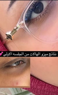 عيادة ايفنت • فيلر وبوتكس • بلازما وشعر