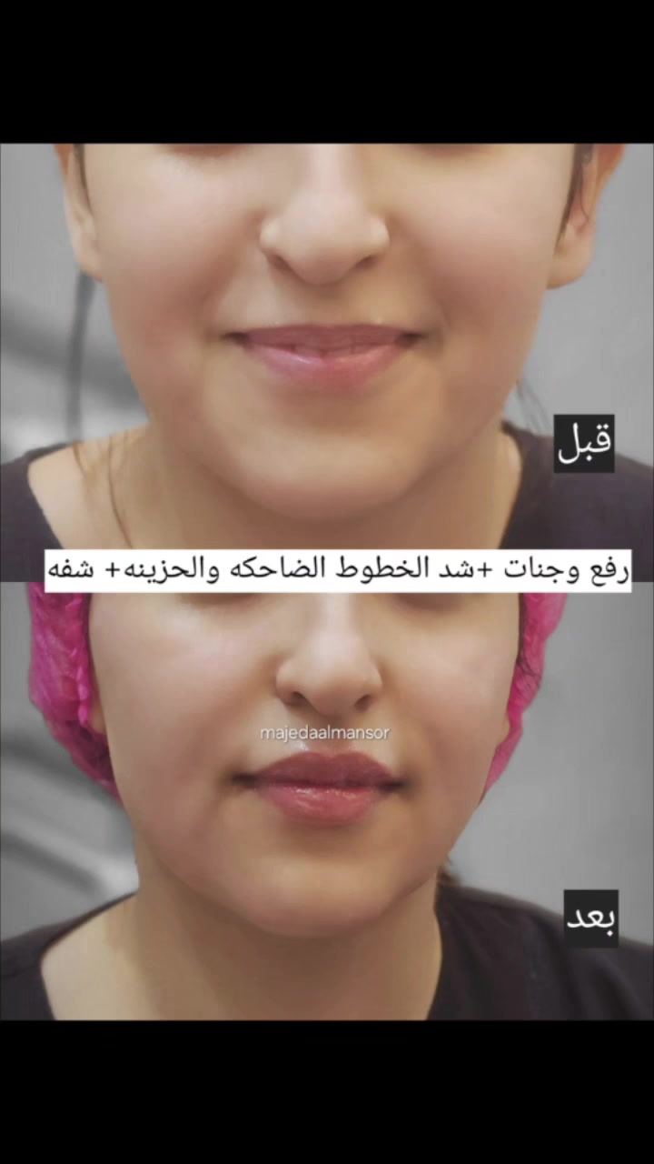 ✨ تغيير چذري ولوك يجنن وية الدكتورة ماجدة المنصور Jojo Alnabeel   ب مجمع سماء الحسينيه الطبي  ! ✨
​بنات الحسينية، شوفي الفيديوات والصور واحكمي بنفسچ على دقة ونظافة الشغل:
​💋 فيلر وتكساس: رسمة شفايف وتحديد ذقن طبيعي.
​💉 بوتوكس وشد: إخفاء تجاعيد الجبهة بجلسة واحدة.
​✨ إبر نضارة فول: إشراقة ولمعان للبشرة.
​🔥 المواد كلها أصلية 100% والنتائج تجنن مثل ما تشوفون بالصور!

بغداد /الحسينيه /مقابل السوق الكبير /مجاور مرطبات العذراء /مجمع سماء الحسينيه الطبي/ طابق ثاني /قسم التجميل والليزر والصالون للحجز والاستفسار ***********
