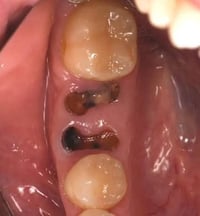 قلع جذور • اسنان متحركة • طقم متحرك مجانا