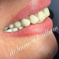 تغليف الأسنان مع زراعة الأسنان للأسنان الخلفية  نوع التغليف زاركون  بي...