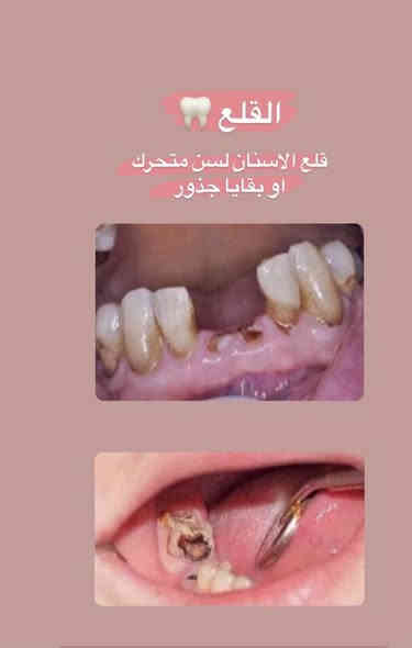 السلام عليكم
اي شخص عنده بقايا جذر او سن منتهي ويريد يقلعه
او عنده تسوس ويريد يسوي حشوة 
وكذلك متوفر طقم اسنان جزئي ومتحرك
متوفر في عيادات جامعة ابن سينا-مقابيل بلدية الرشيد او بانزين خانة البياع
علماً العلاج مجاني
 للإستفسار اكثر تواصل ع خاص او تواصل ع رقم ***********
