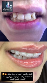 زيركون بسماية • فيلر كوري • بلازمة مفعلة