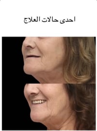 طقم أسنان متحرك • فقدان كامل للأسنان • جامعة العين الاهلية