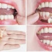 الي يريد يعوض اسنانه المفقودة بطقم جزئي متحرك خلي يتواصل ويانه  078478...