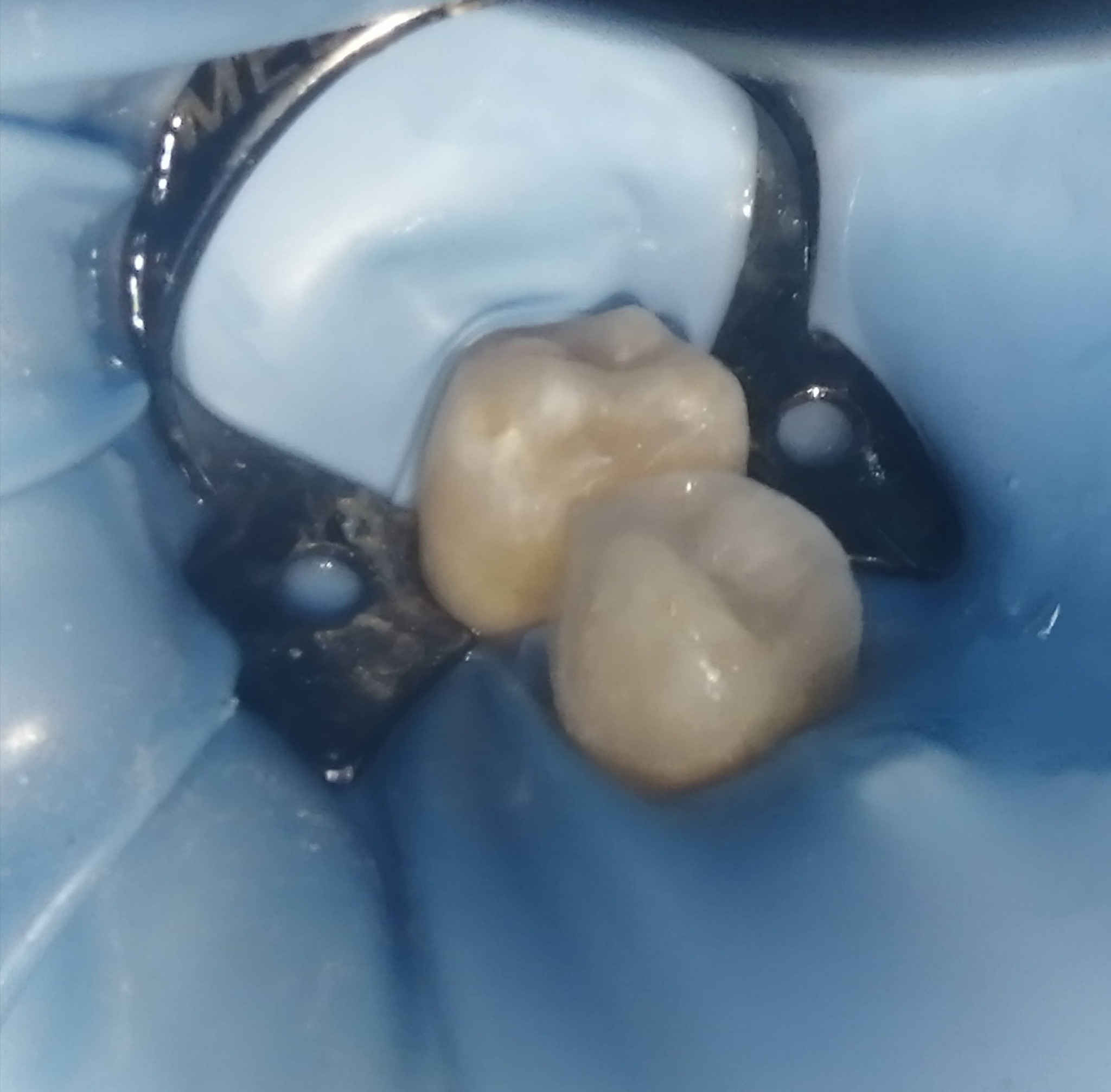 ترميم الأسنان الضواحك السفليه بحشوه تجميليه..
د مهند عبد الجواد الطحان الهاشمي.. ماجستير ودبلوم عالي تعويض الأسنان.. سايدين مستشفى #القياره العام.. مجاور صيدليه عبدالله المعماري. طابق ارضى. ***********#
