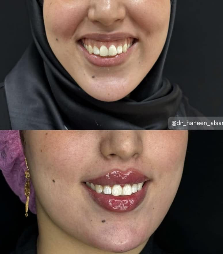 هذا ابدااع الدكتورة حنين الصراف في التجميل في الفلر والبوتوكس والخطوط الضاحكة … شكرا لطبيبة التجميل العراقية بنت 
الكوت


**إذا كنت صاحب هذا الإعلان وتريد حذفه لأي سبب، رجاءا أرسل رسالة إلى الدعم الفني**