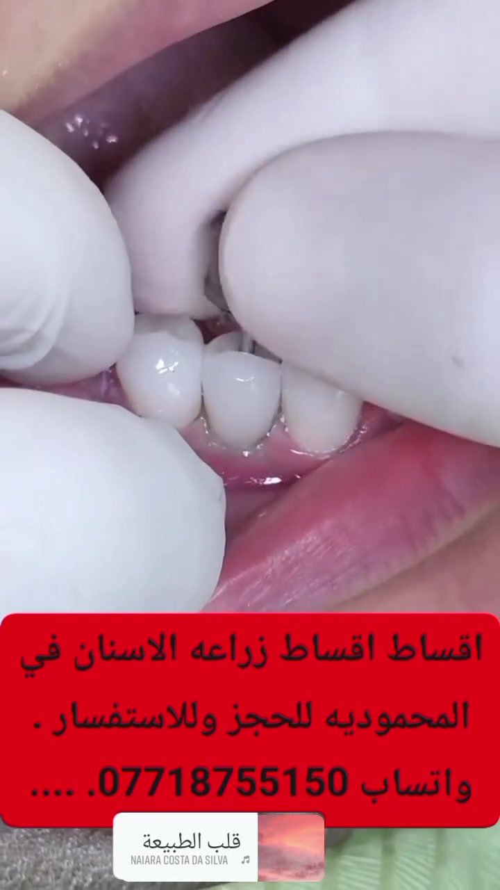 اقساط 
اقساط
🦷 إذا كنت تبحث عن زراعة أسنان بجودة عالية وسعر مناسب... عيادة الدكتور احمد الجنابي لطب وتجميل الاسنان 
لدينا في المحمودية أفضل أنواع زراعة الأسنان بأسعار منافسة، مع نظام تقسيط مريح لتسهيل العلاج.
✨ جودة مضمونة ✨ أسعار مناسبة ✨ أقساط ميسرة ✨ ابتسامة تدوم لسنوات
احجز موعدك الآن واستعد ثقتك بابتسامتك


**إذا كنت صاحب هذا الإعلان وتريد حذفه لأي سبب، رجاءا أرسل رسالة إلى الدعم الفني**