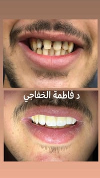 تركيبات ثابتة ومتحركة • تبييض ليزر • اقساط مريحة
