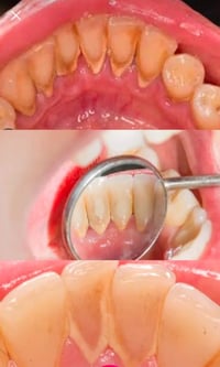 الي عنده تكلسات بسيطه مثل الي بالصور يتواصل وياي هنه أو عل رقم07732249...