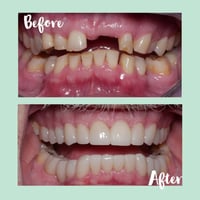 (مجانا)  الي عنده أسنان مفقودة او بقايا جذور ويريد يعوض بمكانها أسنان ...