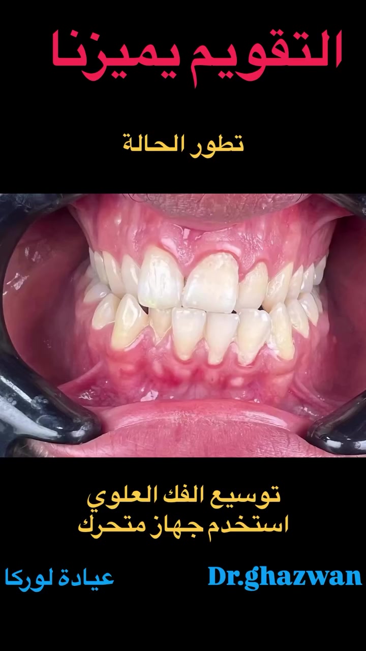 التقويم يميزنا أحد الحالات المعقدة جدا يعاني المريض من عدم مضغ الطعام و عدم او صعوبة نطق الحروف و استمرار في عض اللسان حيث الفك يوضح تضييق في الفكين استخدام جهاز توسيع الفك ثم الانتقال الى مرحلة الجهاز الثابت و ترتيب الاسنان…. علاج جميع حالات التقويم دكتور غزوان مزهر بغداد الكرخ نفق الشرطة بداية شارع الاطباء…متوفر واتس *********** #تقويم_الأسنان_والفكين #تقويمالأسنان #تقويم_الأسنان_بأنواعه #تقويم_الأسنان_قبل_وبعد #تقويم_الشفاف_للأسنان
