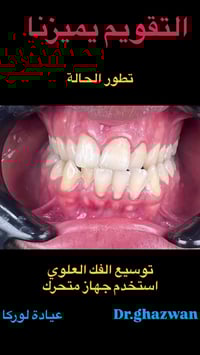 التقويم يميزنا أحد الحالات المعقدة جدا يعاني المريض من عدم مضغ الطعام ...