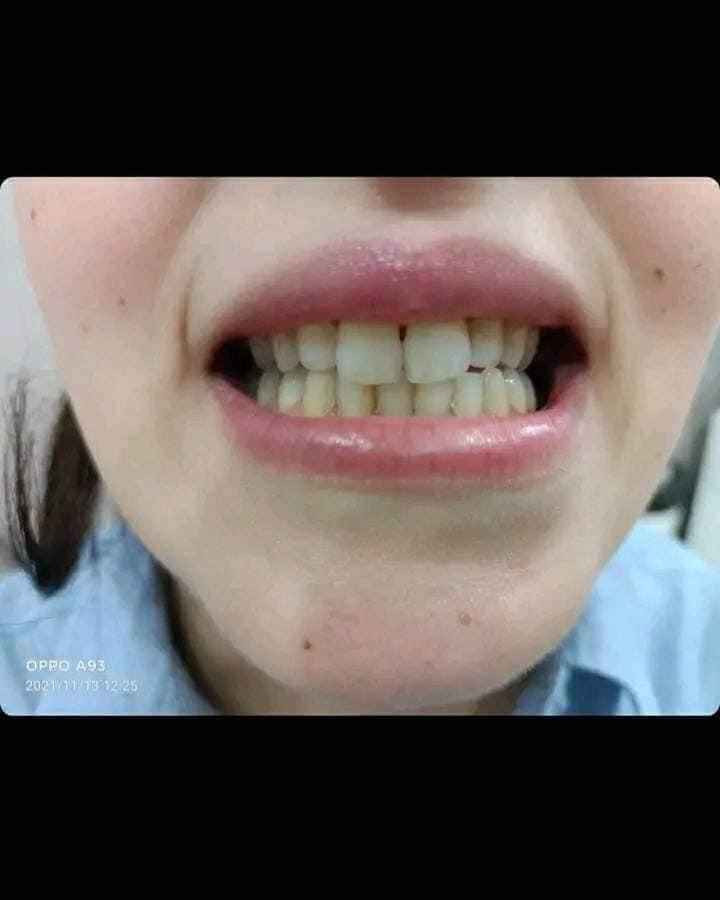 قطرات تبييض الاسنان من   Lanben
 الي يعاني من صفار أسنانه او البقع من كثرة التدخين او شرب الشاي والقهوة والمواد الصبغية 
وحاب يرجع اسنانه بيض انصحك بأستخدم منتج لانبينا للتبييض الأسنان ومن اول استعمال
أسرع مبيض اسنان على الإطلاق يزيل الاصفرار 
❤رجع لمعان ابتسامتك بلحظات  
❤مضمون 100%
السعر خاص بغداد, العراق


**إذا كنت صاحب هذا الإعلان وتريد حذفه لأي سبب، رجاءا أرسل رسالة إلى الدعم الفني**