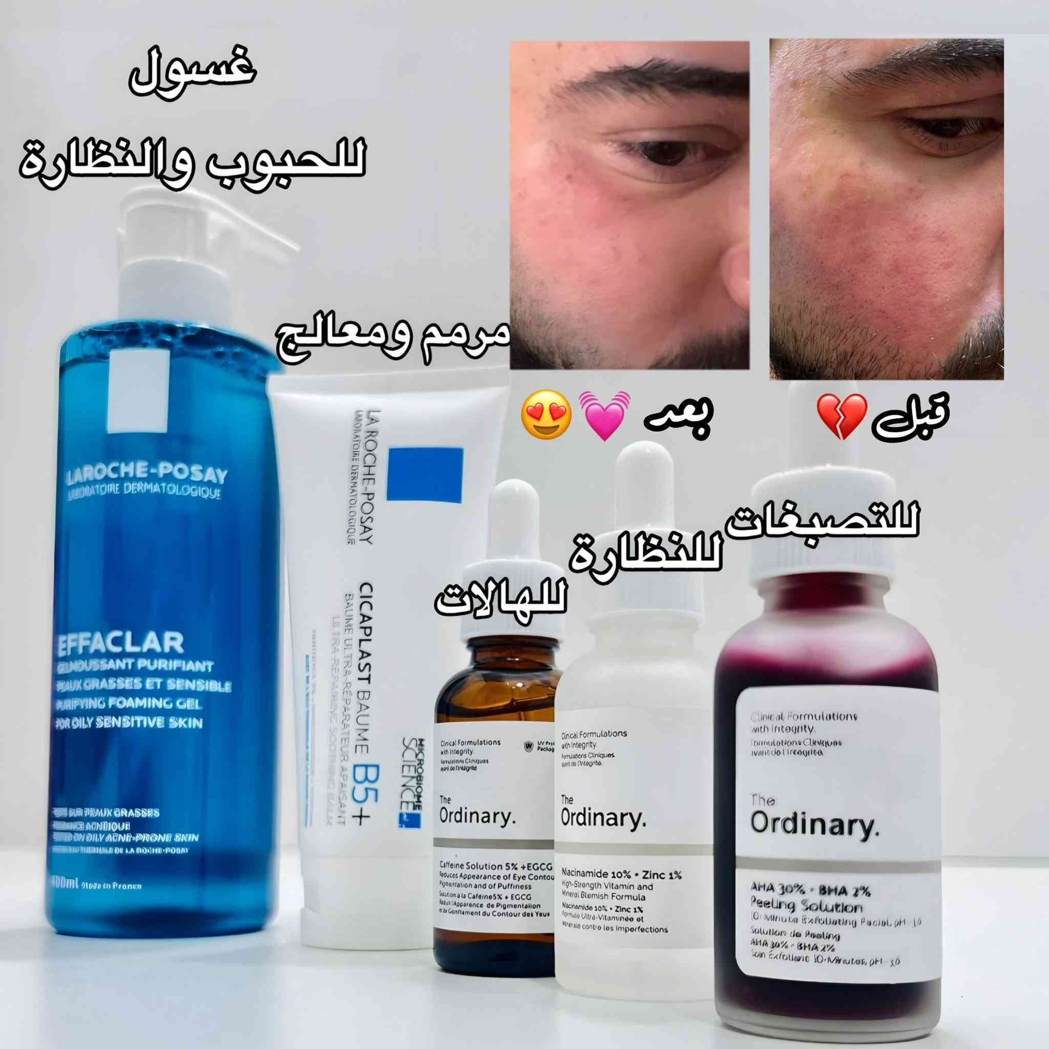 أقوى عرض لعناية متكاملة (Glow Skin) ✨🎉
بكج البشرة الأشهر والأكثر طلباً في متجرنا متوفر الآن من جديد! 😍
البكج المثالي اللي ينطيك نتائج ملحوظة من أول أسبوع ويجمع لك أشهر المنتجات العالمية في بكج واحد 👑👇
📦 محتويات البكج:
 1️⃣ غسول لاروش بوزيه الفرنسي: للحبوب، النضارة، وتنظيف البشرة بعمق 💙
 2️⃣ كريم سيكابلاست B5+: المرطب والمرمم السحري للبشرة ✨
 3️⃣ سيرومات ذا أورديناري (The Ordinary) الثلاثية:
 🧪 سيروم النياسيناميد: للمسام، الآثار، والنضارة.
 🧪 سيروم الكافيين: للهالات والانتفاخ تحت العين.
 🧪 السيروم المقشر (الأحمر): للكلف والتصبغات وتجديد البشرة.

ملاحظات هامة:
 🩺 الفحص عند الاستلام: من حقك تفحص وتتأكد من المنتجات قبل الدفع.
 ⏰ تنويه: العرض ساري لمدة 24 ساعة فقط أو حتى نفاد الكمية!
📥 للحجز أو الاستفسار، ارسل لنا رسالة على الخاص (الاسم، العنوان، ورقم الهاتف) واضمن بكج العناية الخاص بيك!


**إذا كنت صاحب هذا الإعلان وتريد حذفه لأي سبب، رجاءا أرسل رسالة إلى الدعم الفني**