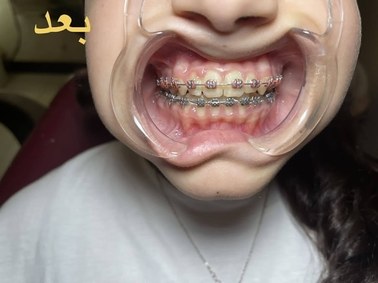 حالات #تقويم_الاسنان التي تم علاجها في عيادة
#دكتور_احمد_طارق_مولود  على يد طبيبة تقويم الاسنان 

#دكتورة_اسيل_اكرم_علي   اختصاص دبلوم عالي تقويم   وتجميل الاسنان 

دورة حي دجلة  - فوق صيدلية دجلة النموذجية 

٠٧٧٤ ٢٢٤ ٨٠٥٠
#علماً ان نظام الدفع #بالتقسيط
