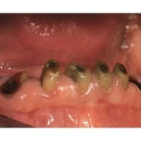 اللي عنده هيج أسنان أو أسنان متحركة لا يتردد بالتواصل معي، لأن هذا دما...