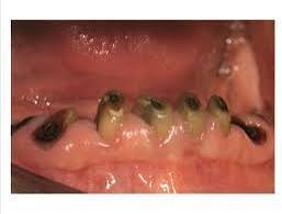 سلام عليكم
الي محتاج:
قلع 
تعويض طقم اسنان كامل او شبه كامل 
حشوات 
تنظيف 
العيادات مفتوحه وبأشراف اطباء اختصاص لكل حالة 
التواصل يكون خاص ماسنجر او على رقم الاتي: 
***********
