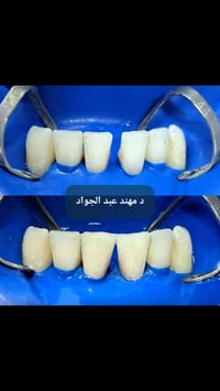 غلق الفلجه • أسنان سفليه • مستشفى القياره