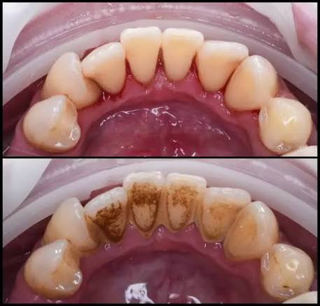 مجانا.
قلع الاسنان التالفه والجذور المتبقيه
حشوات ضوئيه تجميليه 
تنضيف الاسنان 
طقم اسنان متحرك جزئي
علما ان العلاج مجاني 
للتواصل الاتصال على الرقم التالي او التواصل على الواتساب ***********
