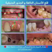 علاج اسنان مجاني • قلع اسنان • الدورة شارع المصافي