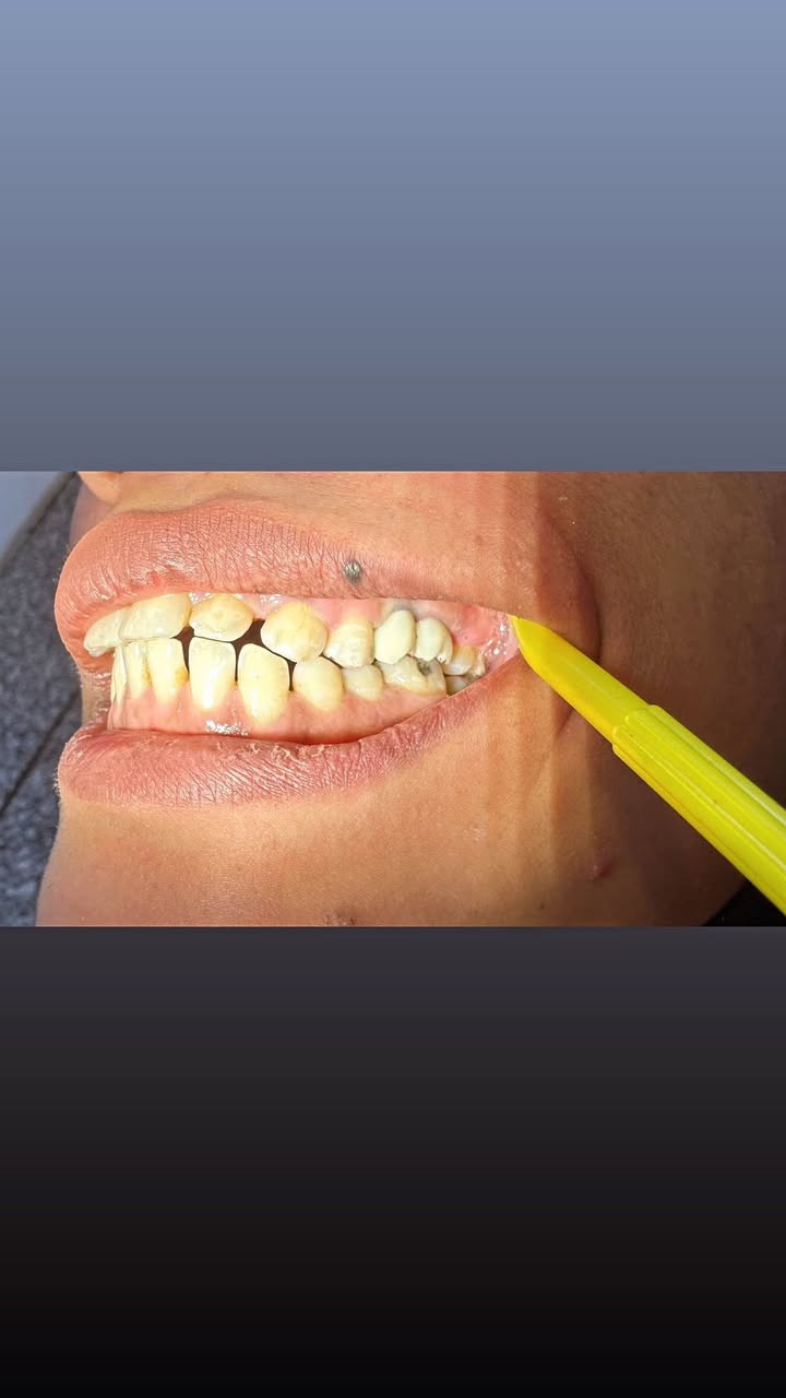 تثبيت زرعات الأسنان بعد ثلاث أشهر من أكتمال عملية 
شفاء العظم واللثة وأكتمال ثباتية الزرعة داخل العظم 
للتواصل والأستفسار عن الزراعة 
الرقم *********** 
د. حسين كاظم العگيلي 
عيادة الآيات لطب الأسنان 
النجف الاشرف - حي الزهراء - شارع المدارس
