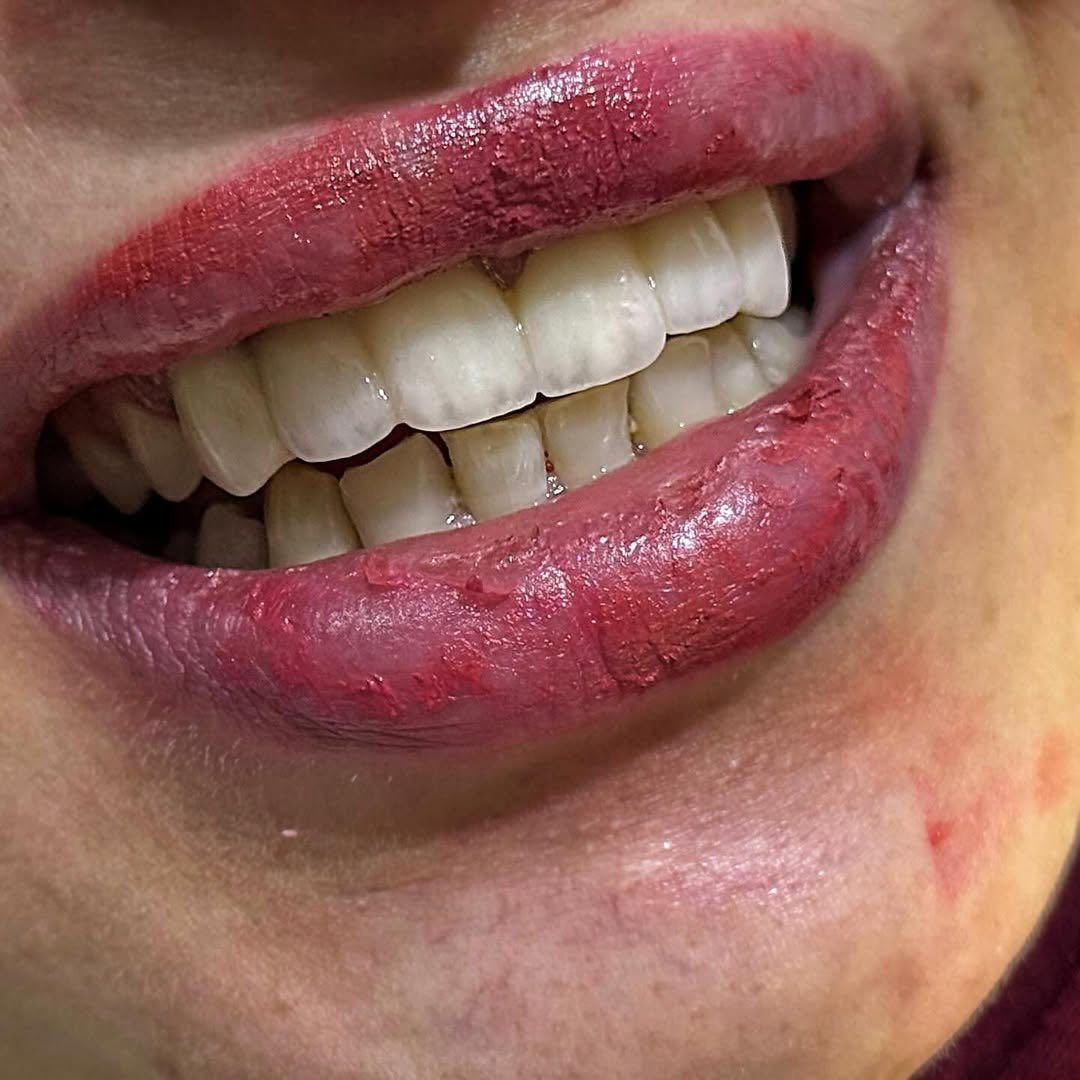 ✨ ابتسامة جديدة… ثقة أكبر ✨

من أول جلسة تگدر تشوف الفرق 👌

تركيب تجميلي يغيّر شكل الابتسامة ويعطي مظهر طبيعي وناصع 🤍

📸 الصورة تحچي عن نفسها – قبل وبعد

📍 عيادة لؤلؤة بدرة

📞 للحجز والاستفسار: ***********

ابتسامتك مسؤوليتنا 🌸

لا تتردد… خلّي ابتسامتك تحچي عنك �
